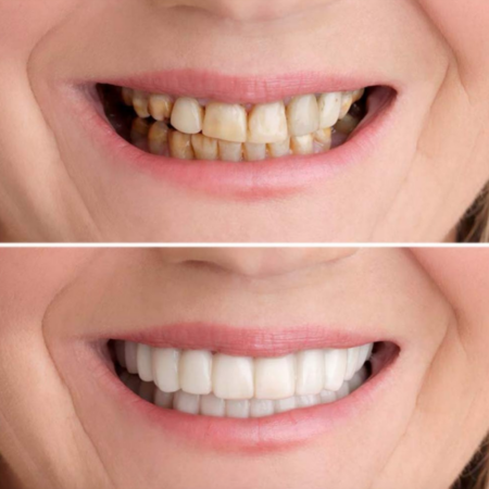 Sorriso Fácil™ - Dentes brancos superior + inferior - Imagem 2