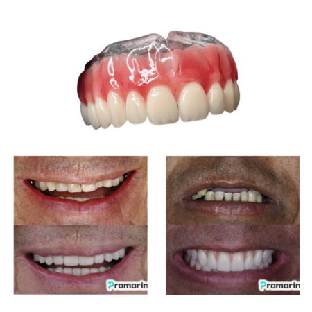 Dentadura de Silicone FIX | Ajustavel e Adaptativa - Image 3