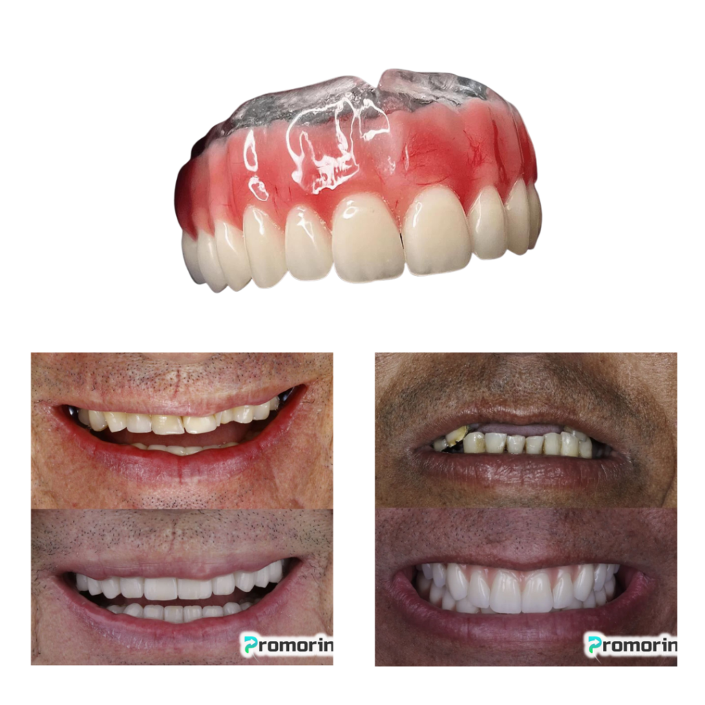 Dentadura de Silicone FIX | Ajustavel e Adaptativa - Imagem 3