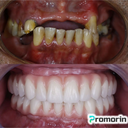 Dentadura de Silicone FIX | Ajustavel e Adaptativa - Image 2