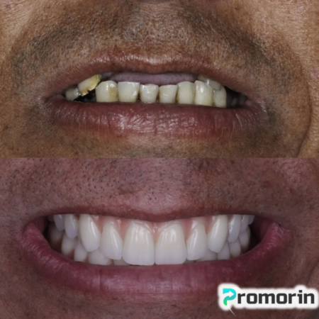 Dentadura de Silicone FIX | Ajustável - Imagem 3