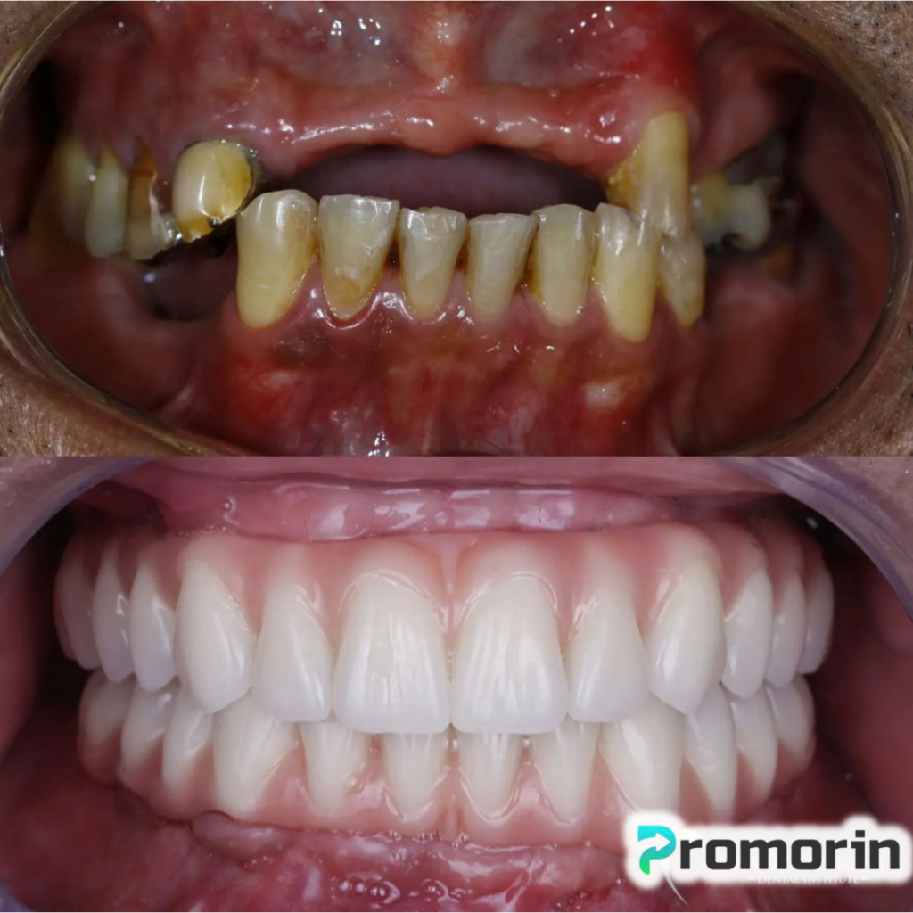 Dentadura de Silicone FIX | Ajustável - Imagem 4