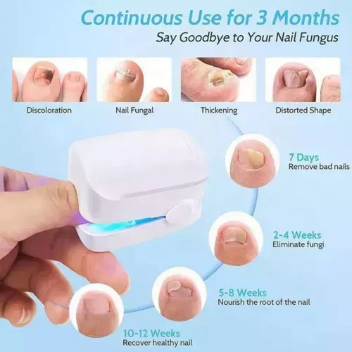 Para A Aparelho A Laser Elimina Fungos Micose Nas Unhas - Imagem 3