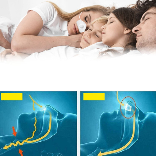 Aparelho Elétrico Anti-ronco Para Dormir, Congestão Nasal Sn - Imagem 12