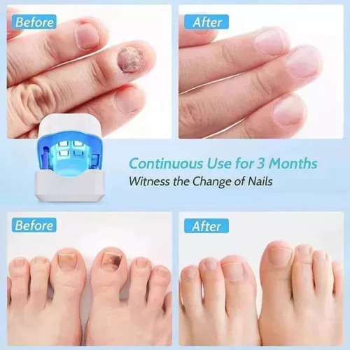 Para A Aparelho A Laser Elimina Fungos Micose Nas Unhas - Imagem 8