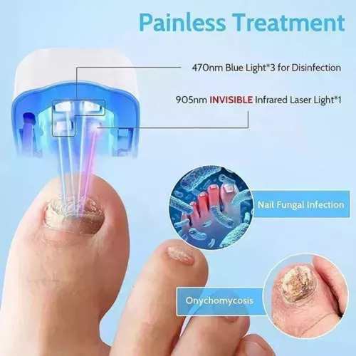 Para A Aparelho A Laser Elimina Fungos Micose Nas Unhas - Imagem 4