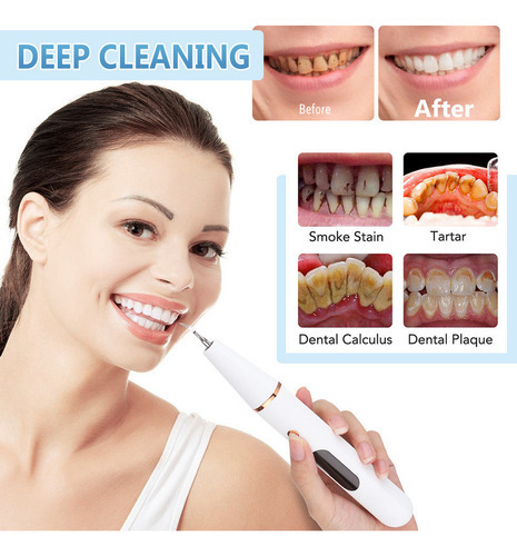 Aparelho Limpeza De Placa E Tártaro Remove Limpa Dentes - Imagem 9