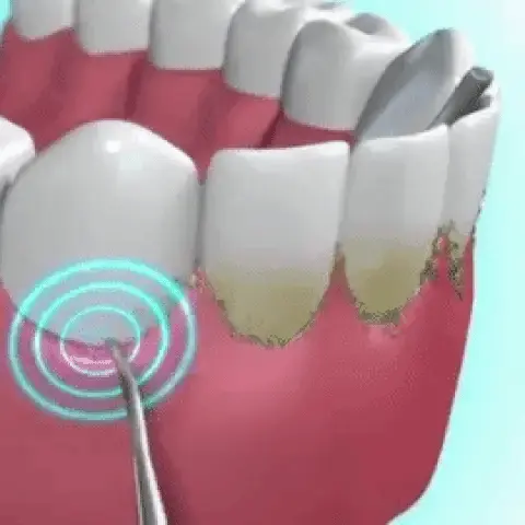 Removedor de Tártaro e Sujeiras - Dental